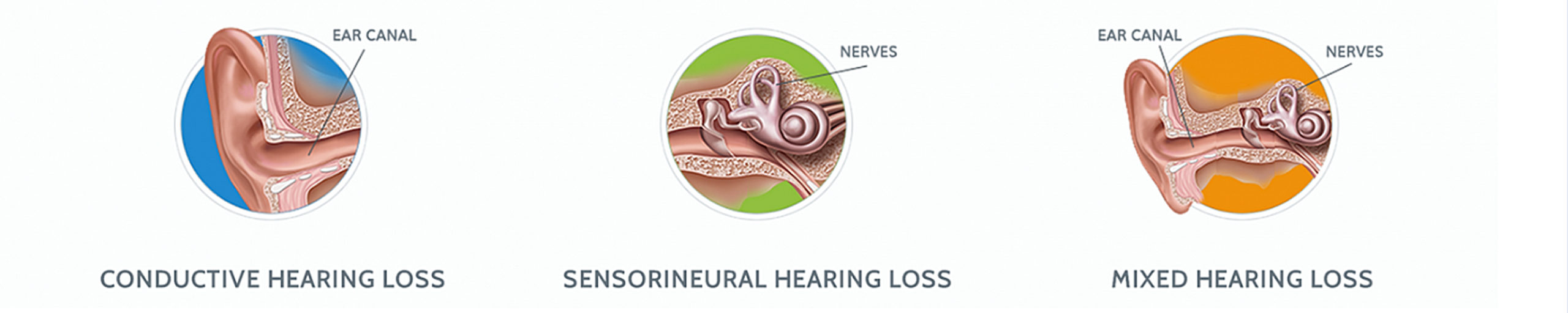 Types Of Hearing Loss Apex Hearing